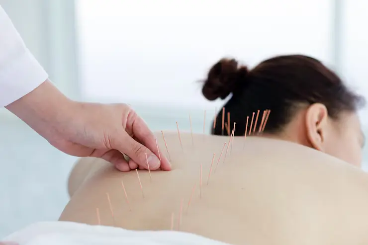 acupuncture therapy for stress
