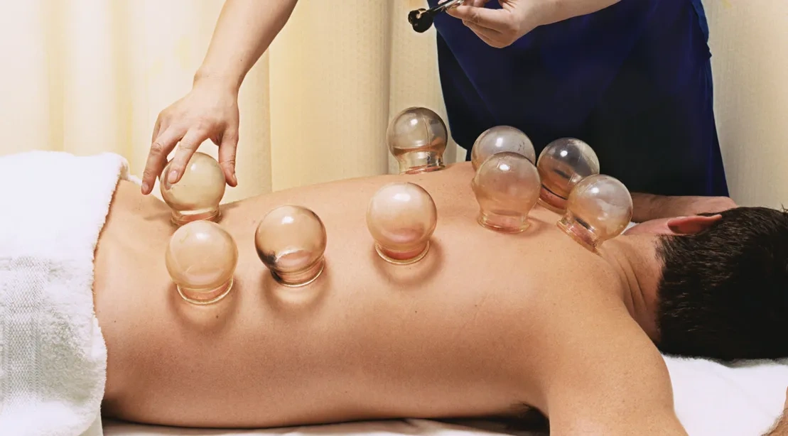 cupping therapy session