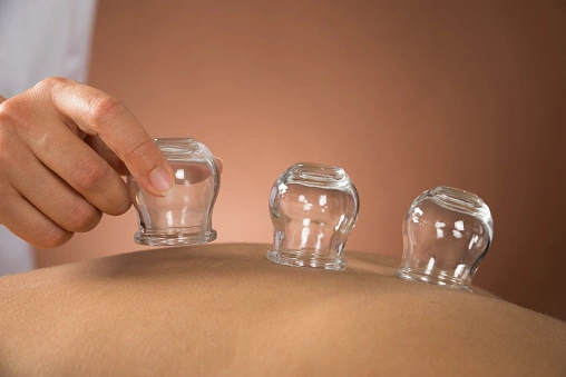 cupping therapy cups